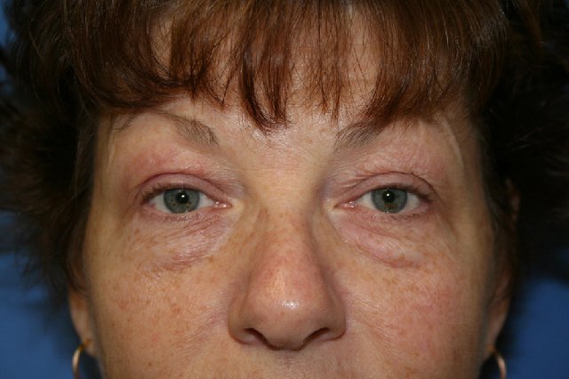 Eyelid Surgery Before
