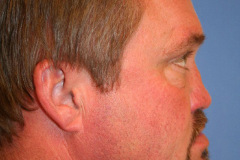 Revision Rhinoplasty