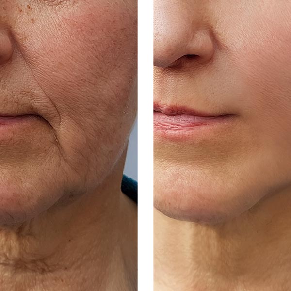 Before and after pictures on a face fat transfer patient.