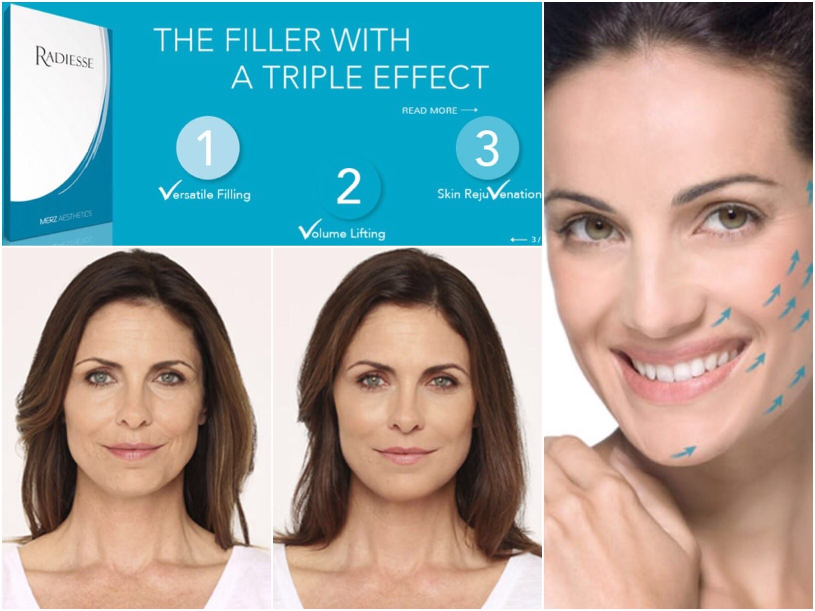 Radiesse Filler Treatment